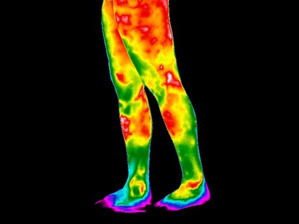 Varicose Veins, Legs. Female. Illustrated with thermography