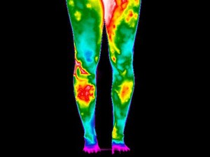 view Varicose Veins, Legs. Female. Illustrated with thermography