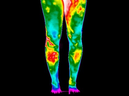 Varicose Veins, Legs. Female. Illustrated with thermography