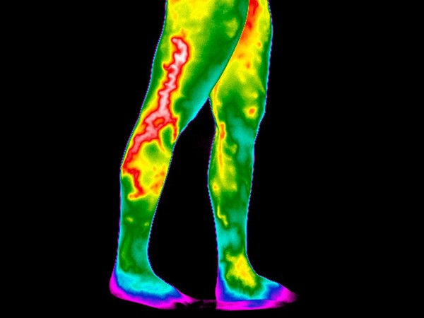 Varicose Veins, Legs. Female. Illustrated with thermography
