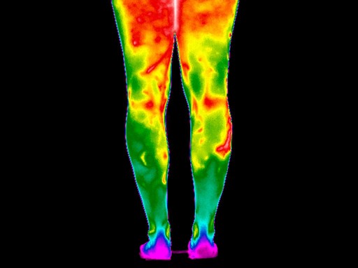 Varicose veins of the leg