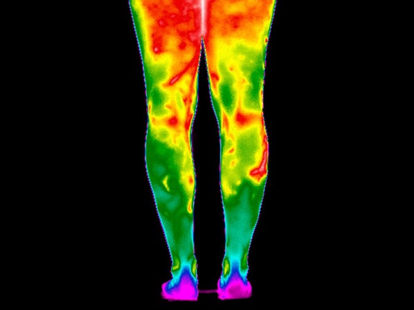 Varicose Veins, Legs. Female. Illustrated with thermography