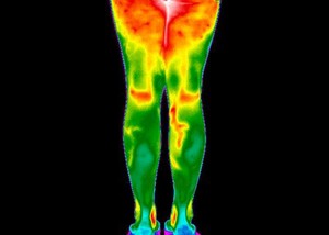 view Varicose Veins, Legs. Female. Illustrated with thermography