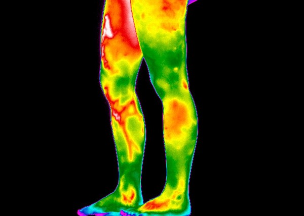 Varicose Veins, Legs. Female. Illustrated with thermography