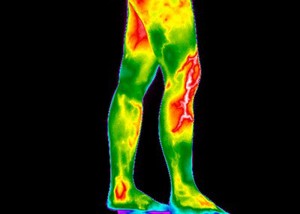 view Varicose Veins, Legs. Female. Illustrated with thermography