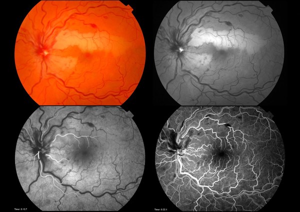 Cilioretinal artery occlusion with CRVO.