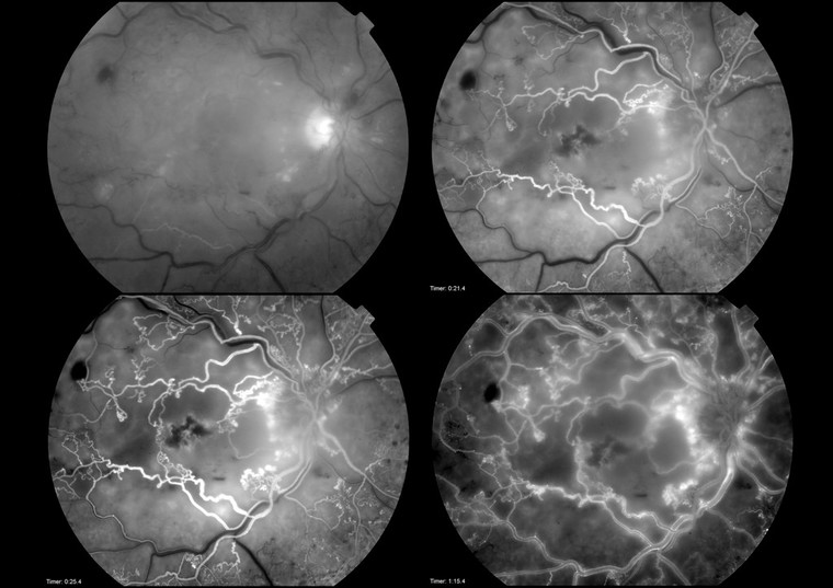 Central Retinal Vein Occlusion (CRVO) Fluorescein Angiography
