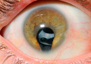 view Iris Coloboma with intra-ocular lens.