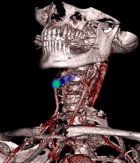 Advances in stroke treatment.