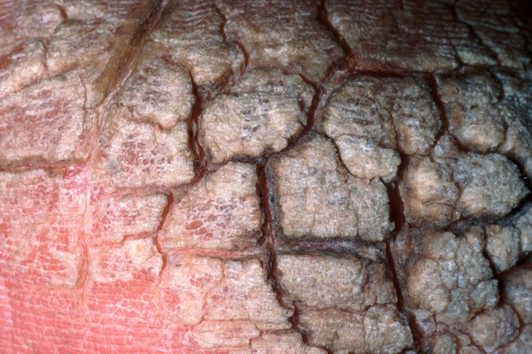 Hyperkeratosis of the heel. Hyperkeratosis describes a thickening of the outer layer of the skin caused by abnormally increased amounts of the protein keratin which normally functions to protect the skin.
