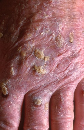 Hyperkeratosis of hand