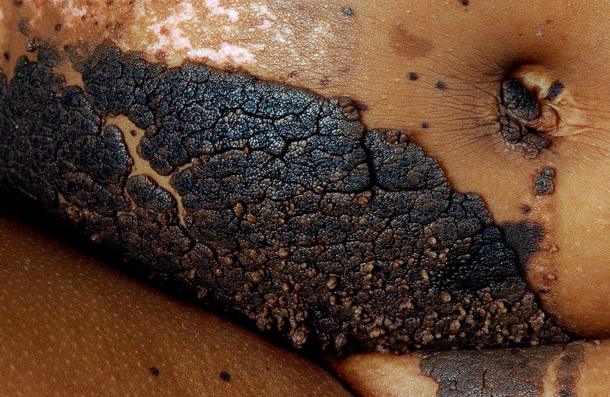Linear sebaceous neavus