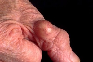 view Pyogenic granuloma on the thumb