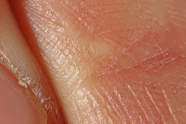 Human dermis scar tissue