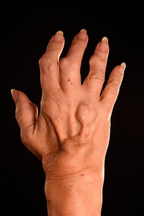 Arthritic Nodules