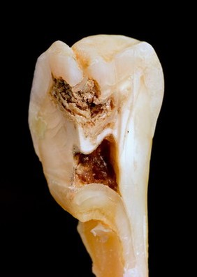 Cross section of a molar with caries