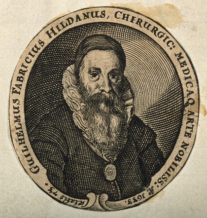 Guglielmus Fabricius of Hilden. Line engraving.