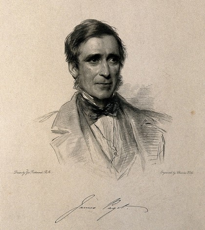 Sir James Paget. Stipple engraving by C. Holl after G. Richmond, 1867.