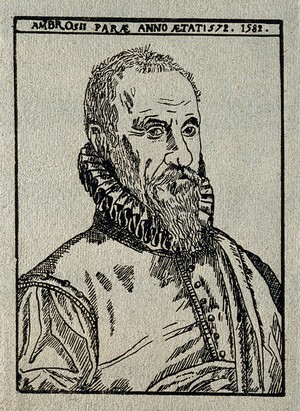 view Ambroise Paré. Reproduction of woodcut after E. Delaune, 1582.