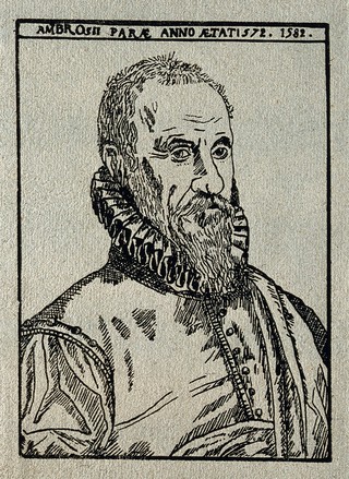 Ambroise Paré. Reproduction of woodcut after E. Delaune, 1582.
