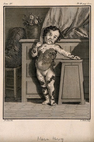 view Anna Maria Herig, a girl with a skin disease: anterior view. Line engraving by C. Baron after J. de Sève, 1777.