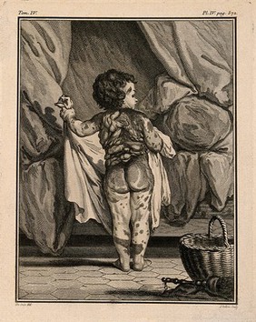 Anna Maria Herig, a girl with a skin disease: posterior view. Line engraving by L.M. Halbou, after J. de Sève, 1777.