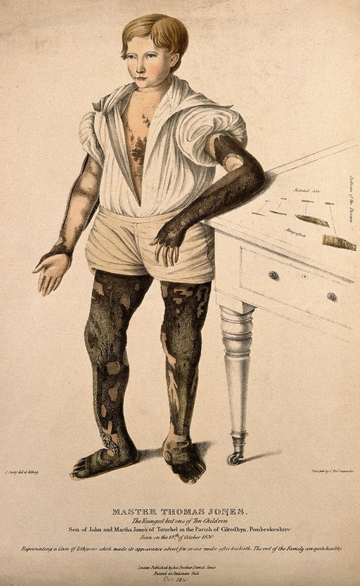 Thomas Jones, a boy with icthyosis, a skin disease that resembles fish scales. Coloured lithograph by J. Perry, 1841.