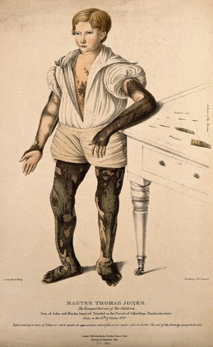 view Thomas Jones, a boy with icthyosis, a skin disease that resembles fish scales. Coloured lithograph by J. Perry, 1841.