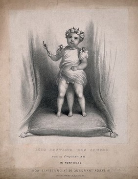 Iòao Baptista dos Santos, a diphallic boy with supernumerary legs. Lithograph by W. Kohler.