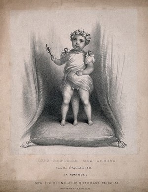 view Iòao Baptista dos Santos, a diphallic boy with supernumerary legs. Lithograph by W. Kohler.
