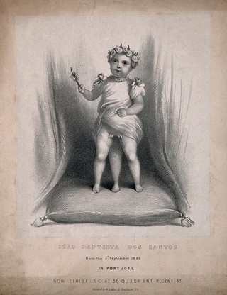 Iòao Baptista dos Santos, a diphallic boy with supernumerary legs. Lithograph by W. Kohler.