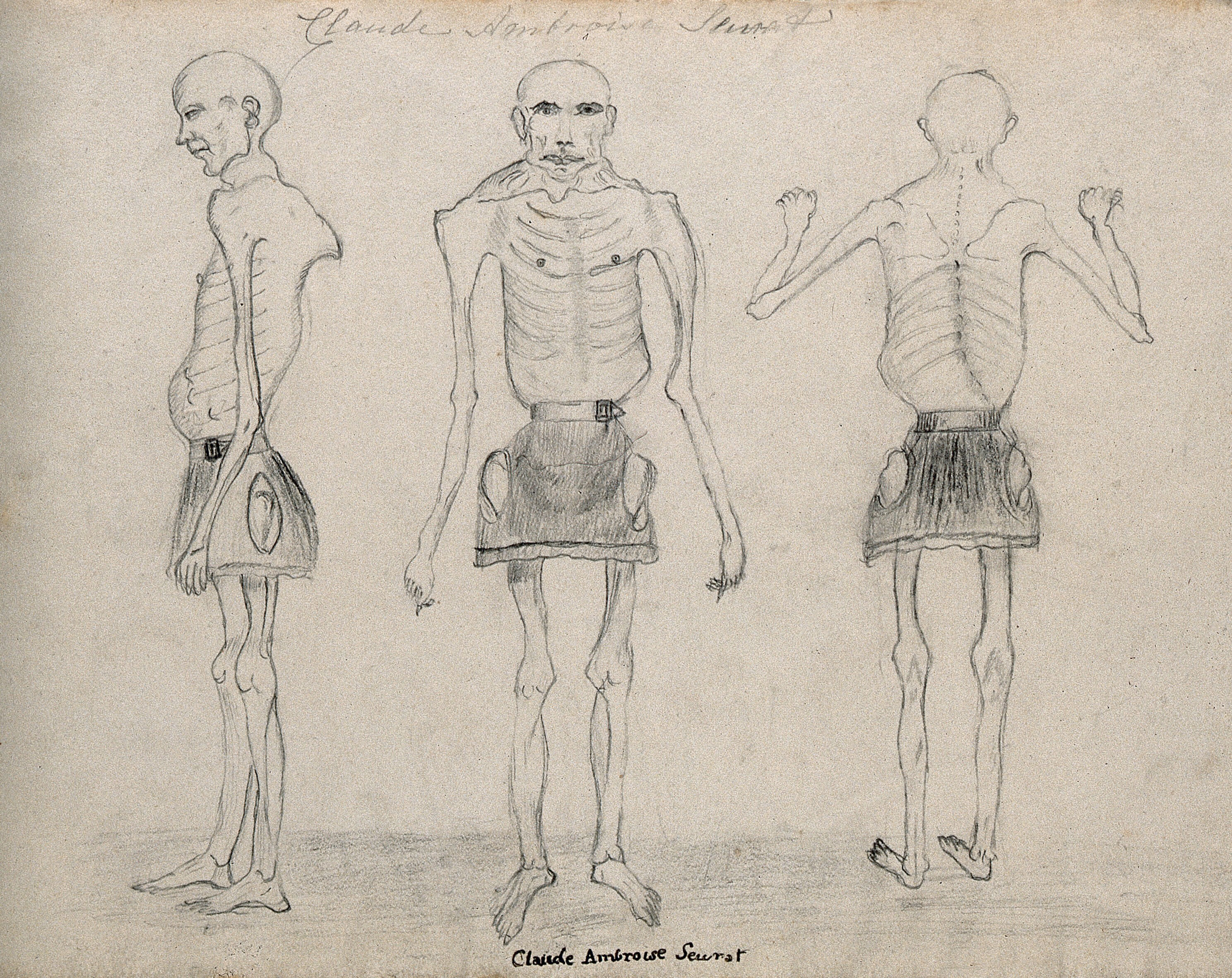 Claude Ambroise Seurat A Very Thin Man Who Was Known As The Human Skeleton Drawing Wellcome Collection