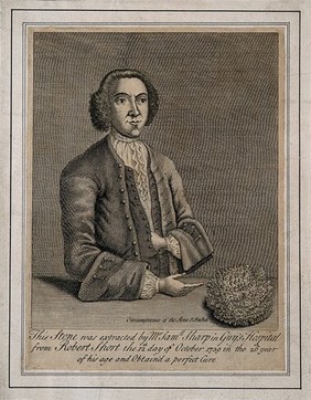 Robert Short, who had a bladder-stone removed which was eight inches in circumference. Engraving.