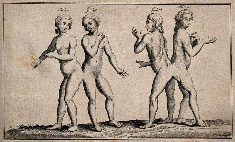 Hélène and Judith, siamese twins, known as the Hungarian sisters. Etching by B. Cole., by Benjamin Cole