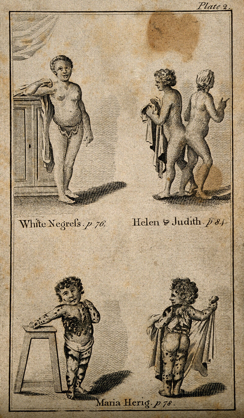 Four figures: Geneviève, an albino woman of African descent, with white instead of black skin; the conjoint twins Hélène and Judith; and Maria Herig who had a skin disease. Engraving after J. de Sève, 1777., by Jacques de Sève