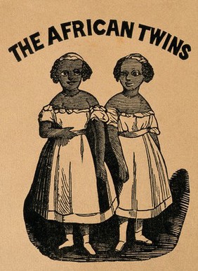 Conjoint twins, known as the African Twins. Wood engraving.