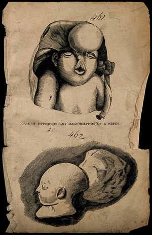 view A malformed foetus. Wood engraving.