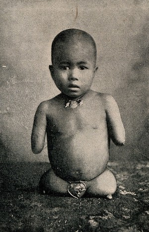 view A child with stumps for its limbs, being exhibited. Reproduction of a photograph.