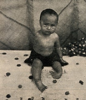 A girl born without an arm. Reproduction, 1905, of a photograph by G. Kelly.