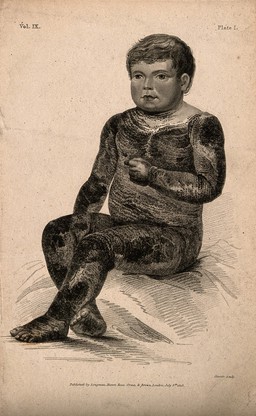 A boy with a variety of icthyosis, a skin disease, which in this case resembles the scales of an alligator. Stipple engraving by R.W. Sievier, 1818.