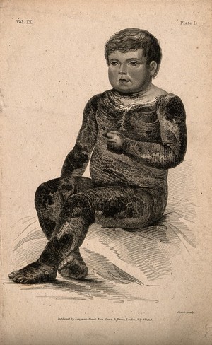 view A boy with a variety of icthyosis, a skin disease, which in this case resembles the scales of an alligator. Stipple engraving by R.W. Sievier, 1818.