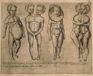 view Four grotesquely deformed children. Line engraving.