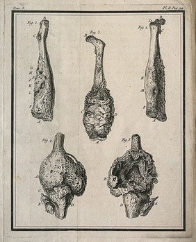 Five figures of exostoses (tumours) on the left femur (thigh-bone) Engraving, 1749.