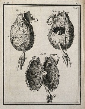 A false ankylosis of the right femur (thigh-bone), seen from the front and back (figs 1-2) and divided for an interior view (fig. 3) Engraving, 1749.