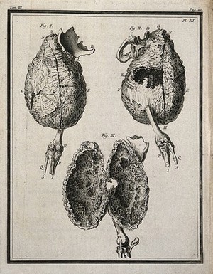 view A false ankylosis of the right femur (thigh-bone), seen from the front and back (figs 1-2) and divided for an interior view (fig. 3) Engraving, 1749.