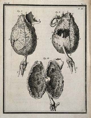 A false ankylosis of the right femur (thigh-bone), seen from the front and back (figs 1-2) and divided for an interior view (fig. 3) Engraving, 1749.
