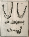 view An ankylosis of the bones of the fractured right femur (thigh-bone) and tibia (lower leg bone) (figs 1-2) and the radius and ulna (bones of the forearm) joined by a flexible callus (figs 3-4) Engraving, 1749.