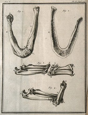 An ankylosis of the bones of the fractured right femur (thigh-bone) and tibia (lower leg bone) (figs 1-2) and the radius and ulna (bones of the forearm) joined by a flexible callus (figs 3-4) Engraving, 1749.
