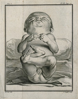 A female foetus of six inches in length with over-developed genitals. Engraving by J. Daullé after J. de Sève, 1749.