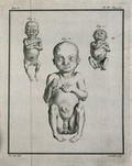 view Three figures of foetuses with hermaphroditic genitals. Engraving by J. Daullé after J. de Sève, 1749.